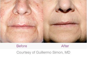 facial veins treatment before and after